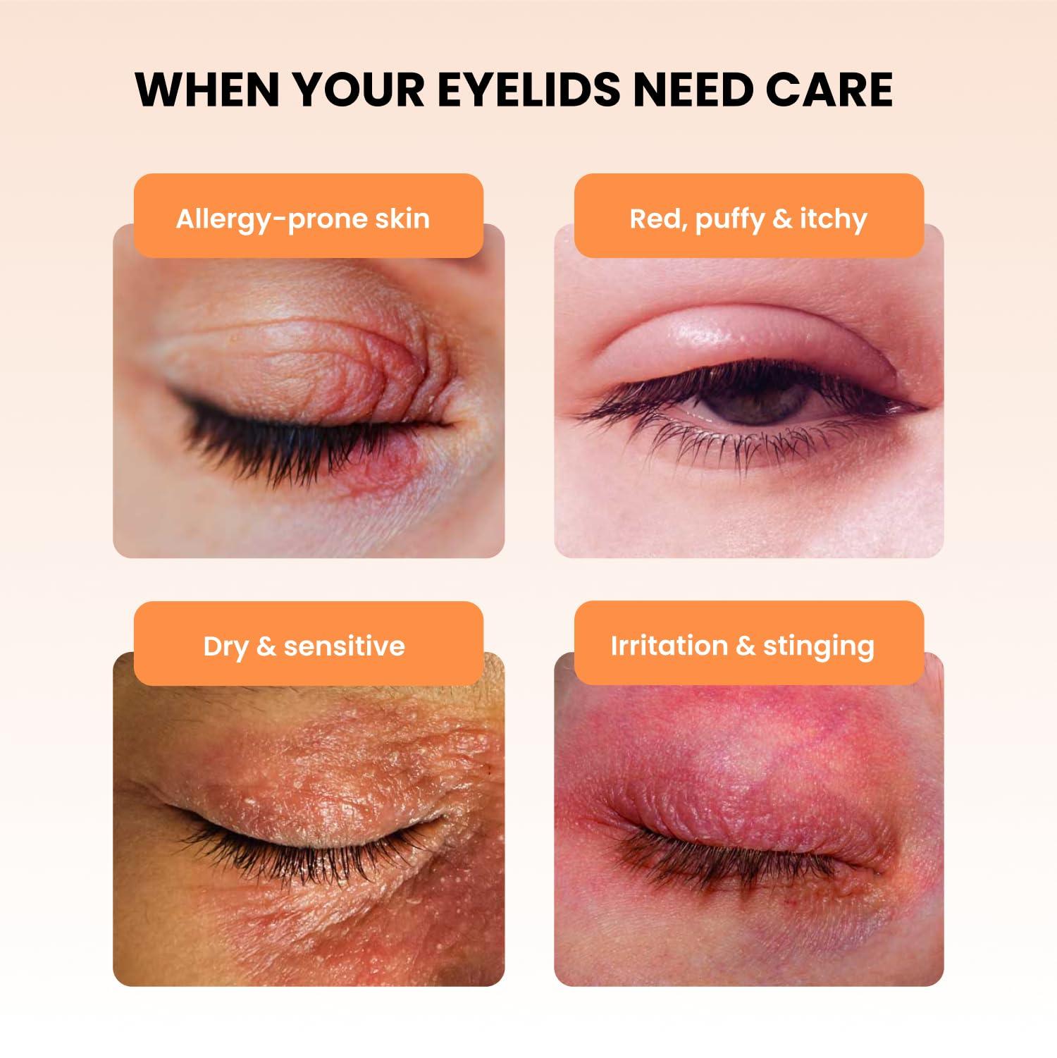 THEA PHARMA BLEPHADERM Soothing Eyelid and Eye Contour Cream - Soothes, Protects, Repairs, Moisturises And Reduces Puffiness - for sensitive, dry, irritated, skin around the eye area. 40ml