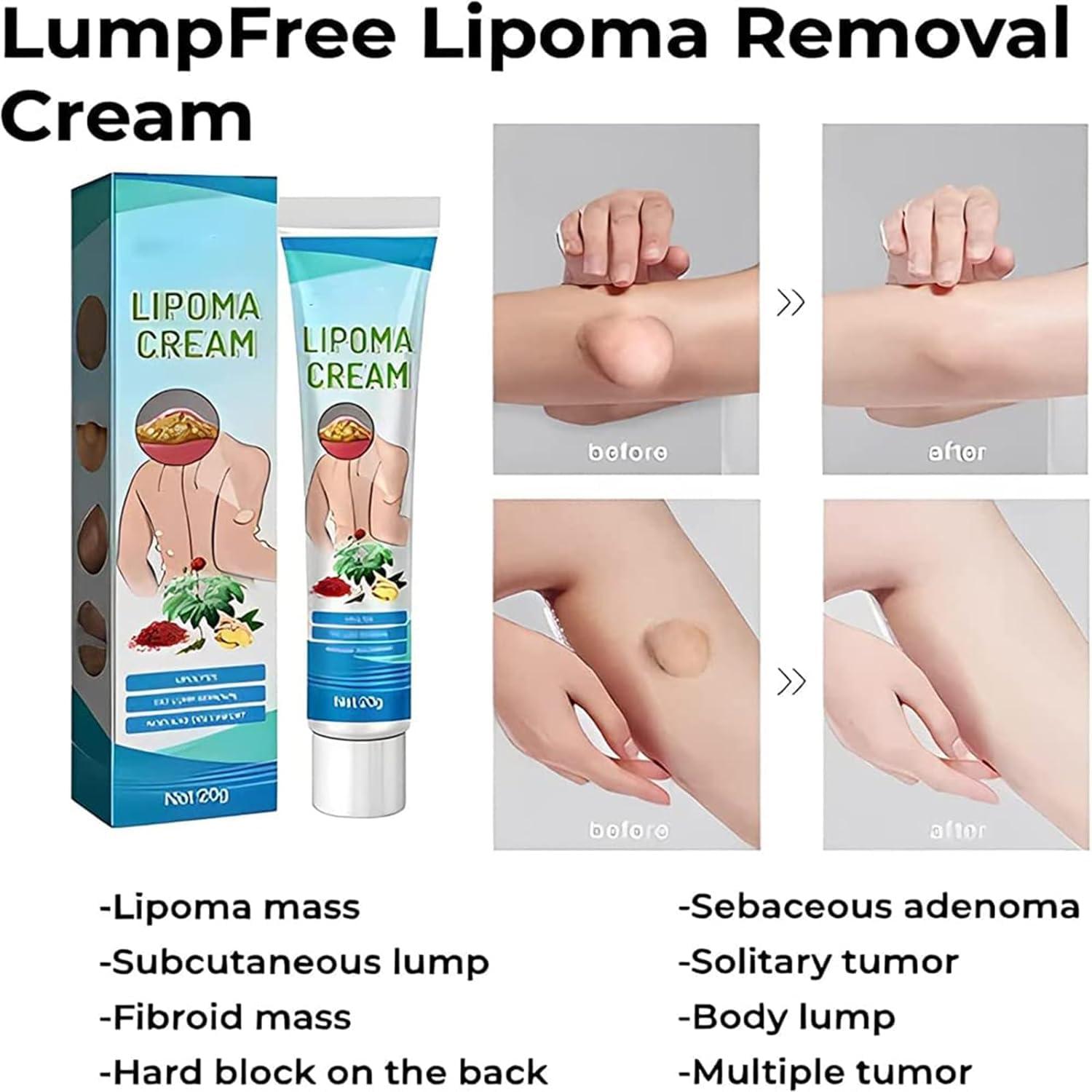 Giurui Lumpfree Lipoma Removal Cream,Lump Free Lipoma Removal Ointment Humans for Fatty Tissue, Removal Relieving Subcutaneous Lumps (3 Pcs)