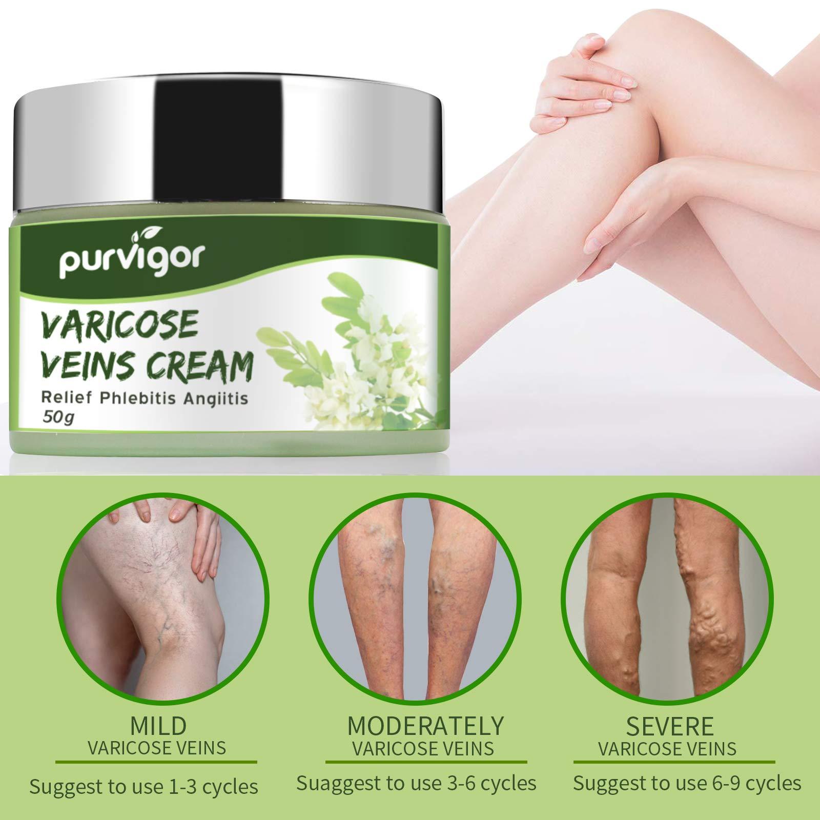 purvigor Varicose Veins Cream, Varicose Vein & Soothing Leg Cream, Natural Varicose & Spider Veins Treatment, Strengthen Capillary Health, Improve Blood Circulation, Tired and Heavy Legs Fast Relief