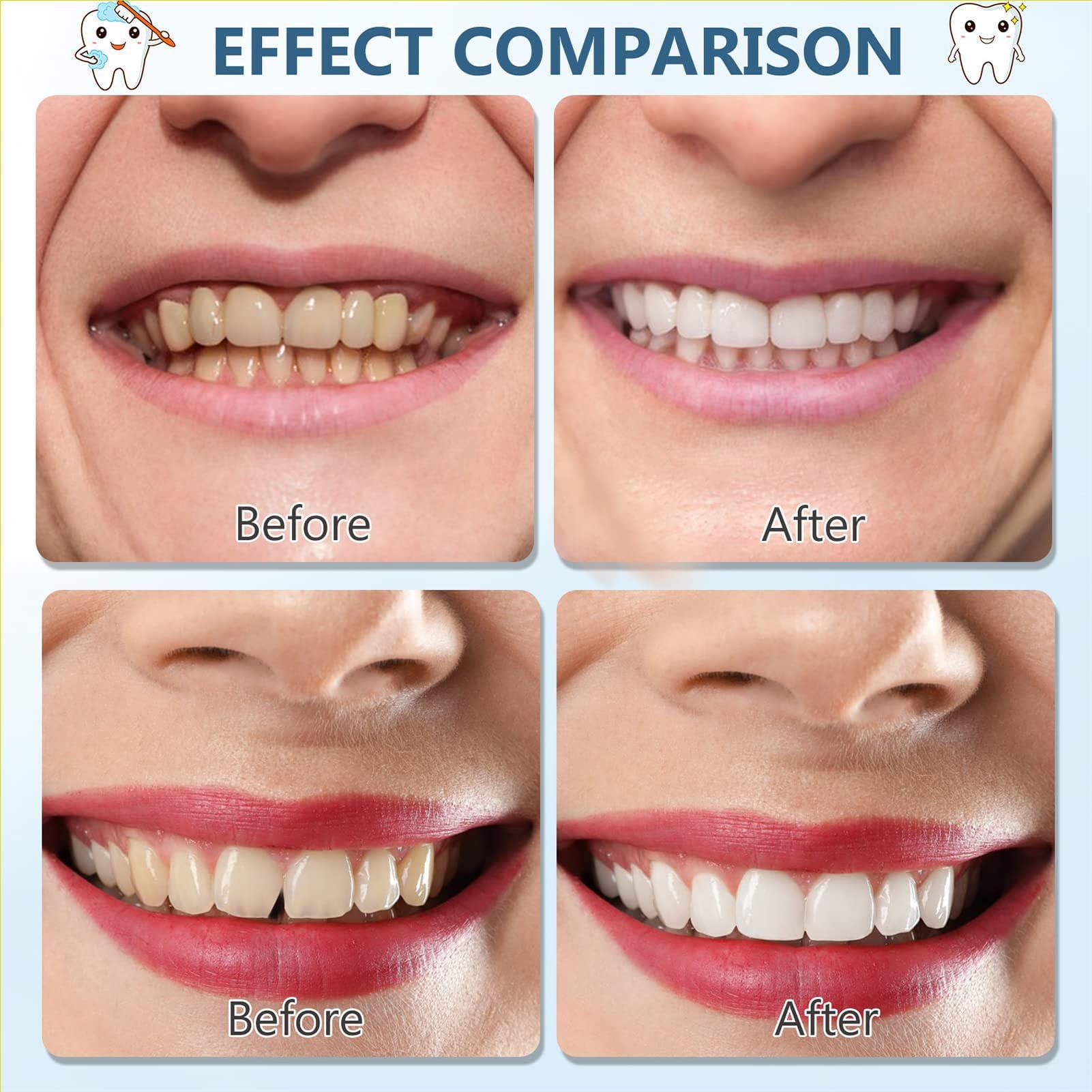 Brigtviee Brigtviee Silicone Reline Denture Set, 2 Pair of Snap-On Dentures Set Upper & Lower,Veneers Snap in Teeth Teeth Comfort Fit, for Men Women with Bad Teeth