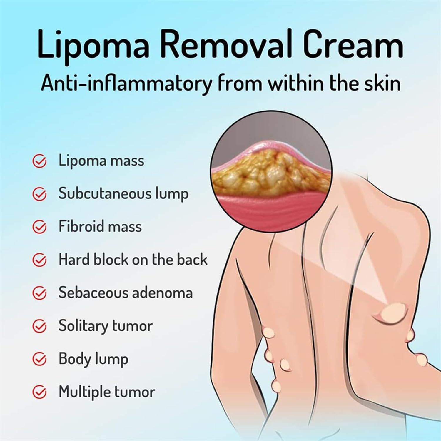 Giurui Lumpfree Lipoma Removal Cream,Lump Free Lipoma Removal Ointment Humans for Fatty Tissue, Removal Relieving Subcutaneous Lumps (3 Pcs)