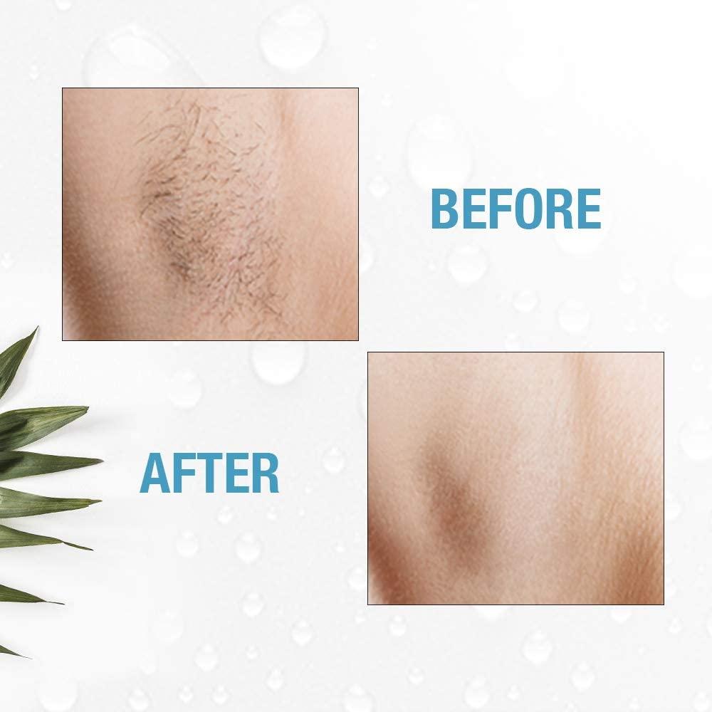 GIGI Clean & Easy Deluxe Home Electrolysis Permanent Hair Removal Kit