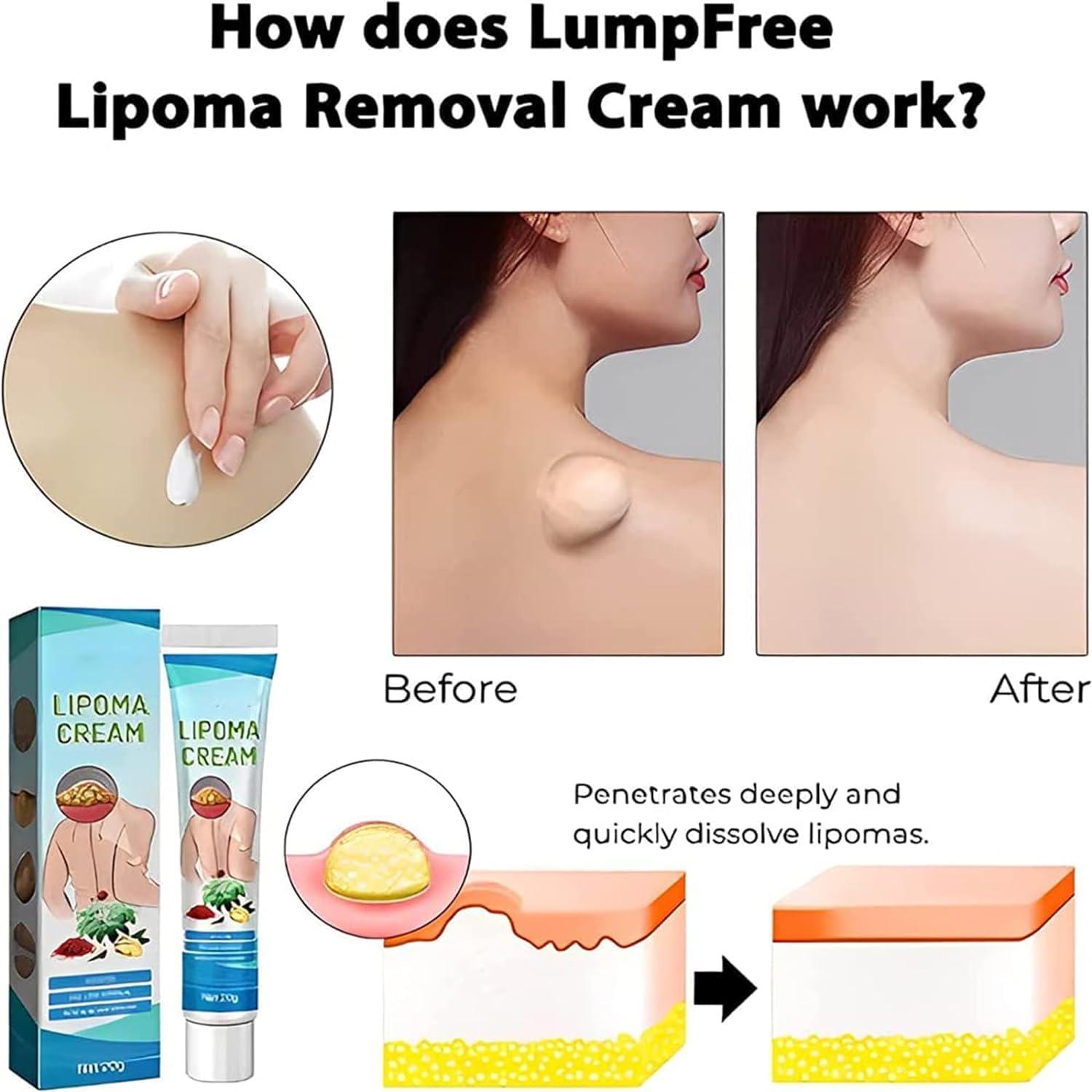 Giurui Lumpfree Lipoma Removal Cream,Lump Free Lipoma Removal Ointment Humans for Fatty Tissue, Removal Relieving Subcutaneous Lumps (3 Pcs)
