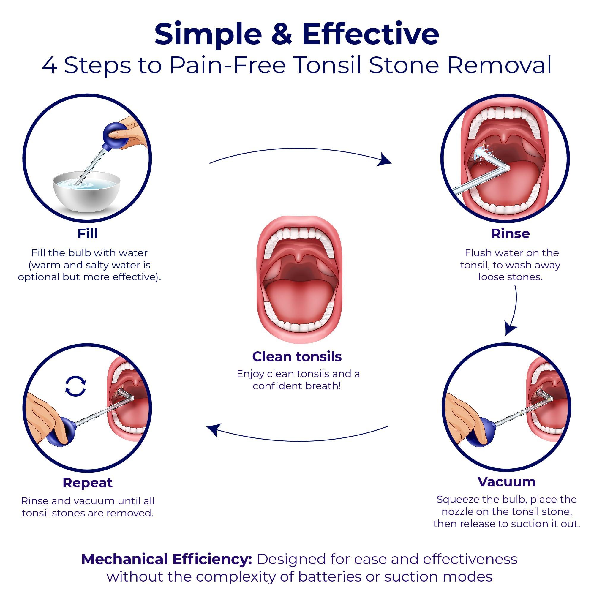 ORAVIX Oravix Tonsil Stone Remover Vacuum, Tonsil Stone Remover for Bad Breath Treatment, Tonsil Stone Suction Tool, Tonsil Stones Remover, Tonsil Stone Remover Vacuum Pump, Tonsil Stone Vacuum