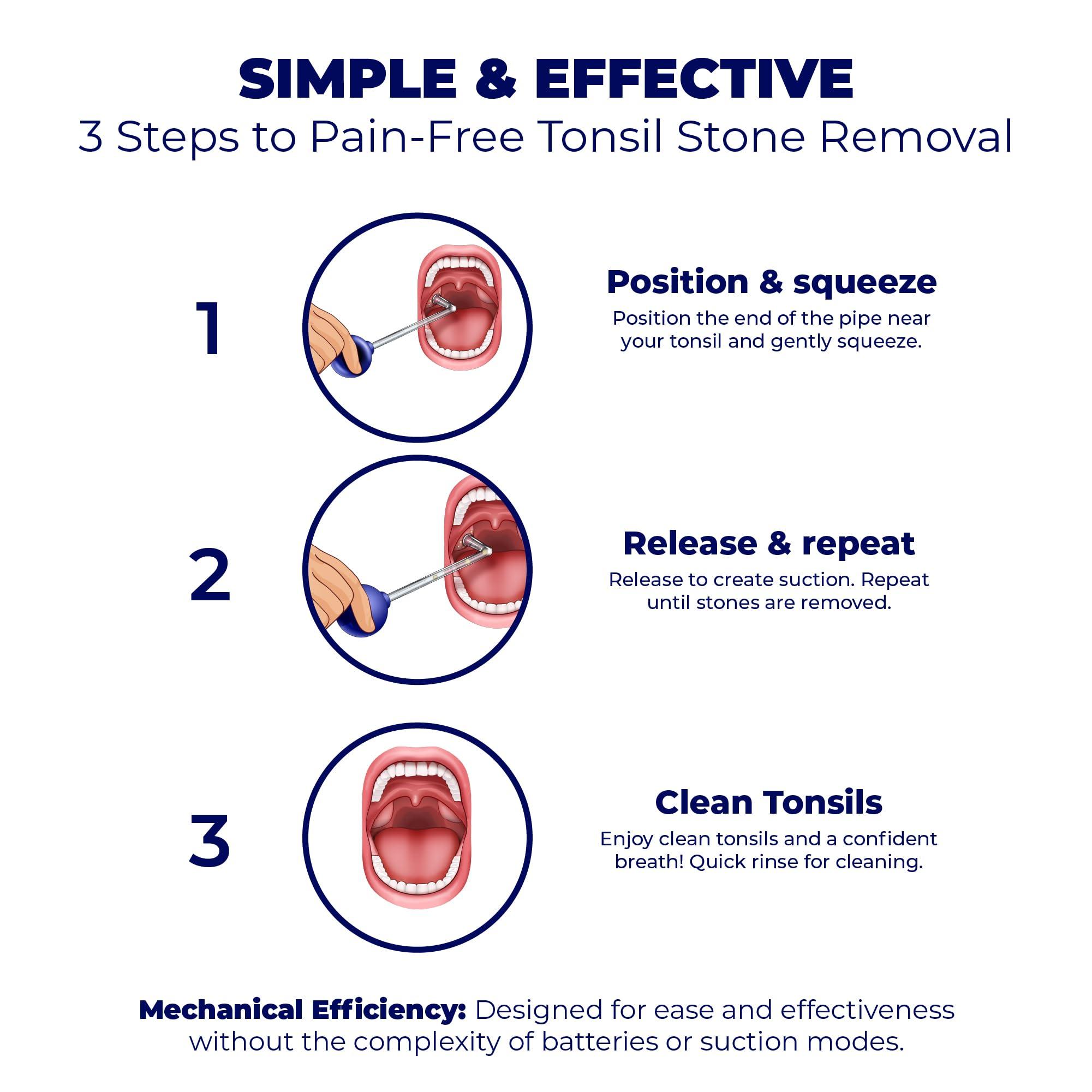 ORAVIX Oravix Tonsil Stone Remover Vacuum, Tonsil Stone Remover for Bad Breath Treatment, Tonsil Stone Suction Tool, Tonsil Stones Remover, Tonsil Stone Remover Vacuum Pump, Tonsil Stone Vacuum