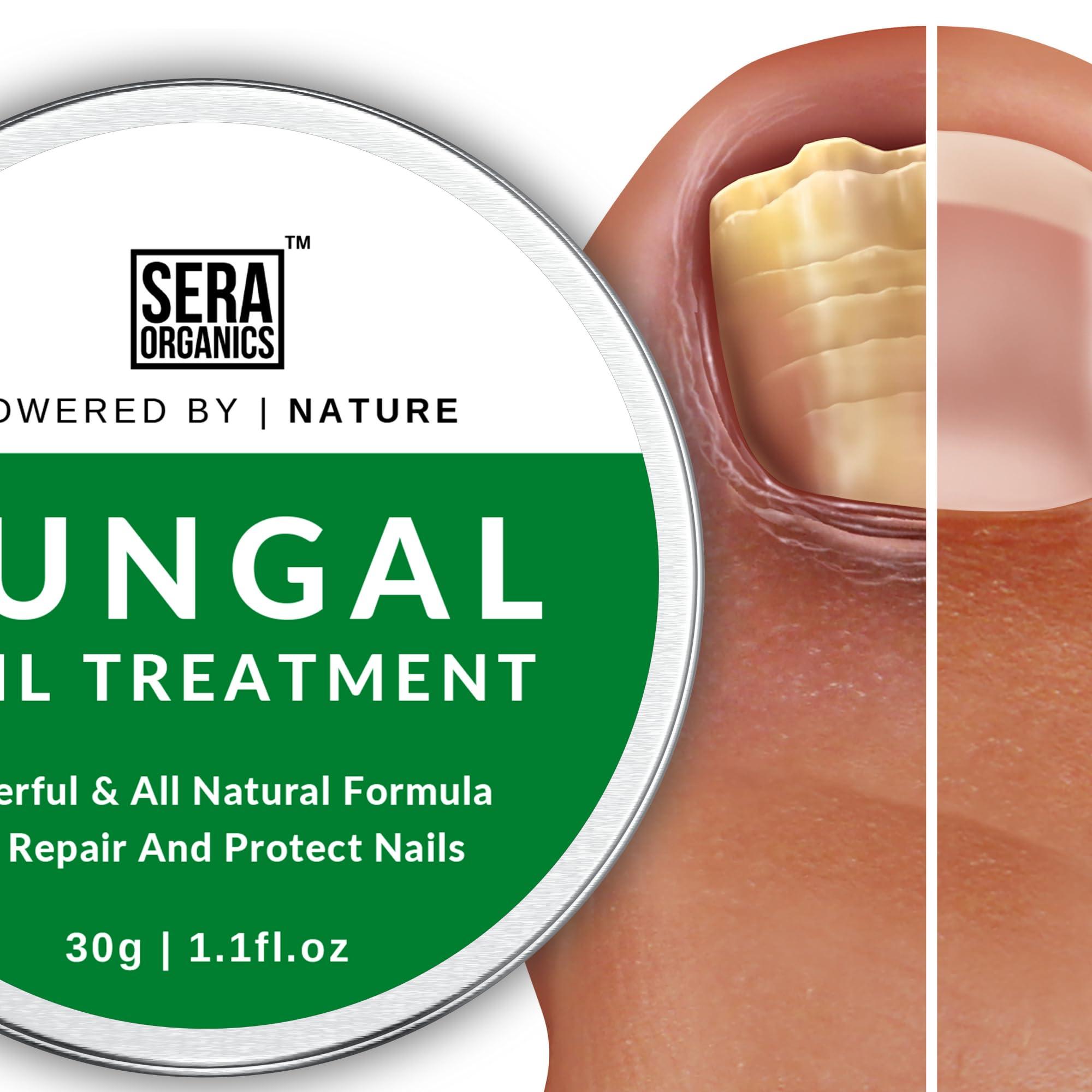 Sera Organics Fungal Nail Treatment Cream - Antifungal Ingredients Natural Strong Anti-Fungal Nail Treatment For Toenail Fungus, Foot Cream With Nourishing Oils For Nail Growth & Nail Repair (30ml) By Sera Organics