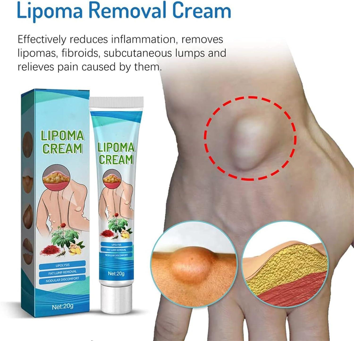 Giurui Lumpfree Lipoma Removal Cream,Lump Free Lipoma Removal Ointment Humans for Fatty Tissue, Removal Relieving Subcutaneous Lumps (3 Pcs)