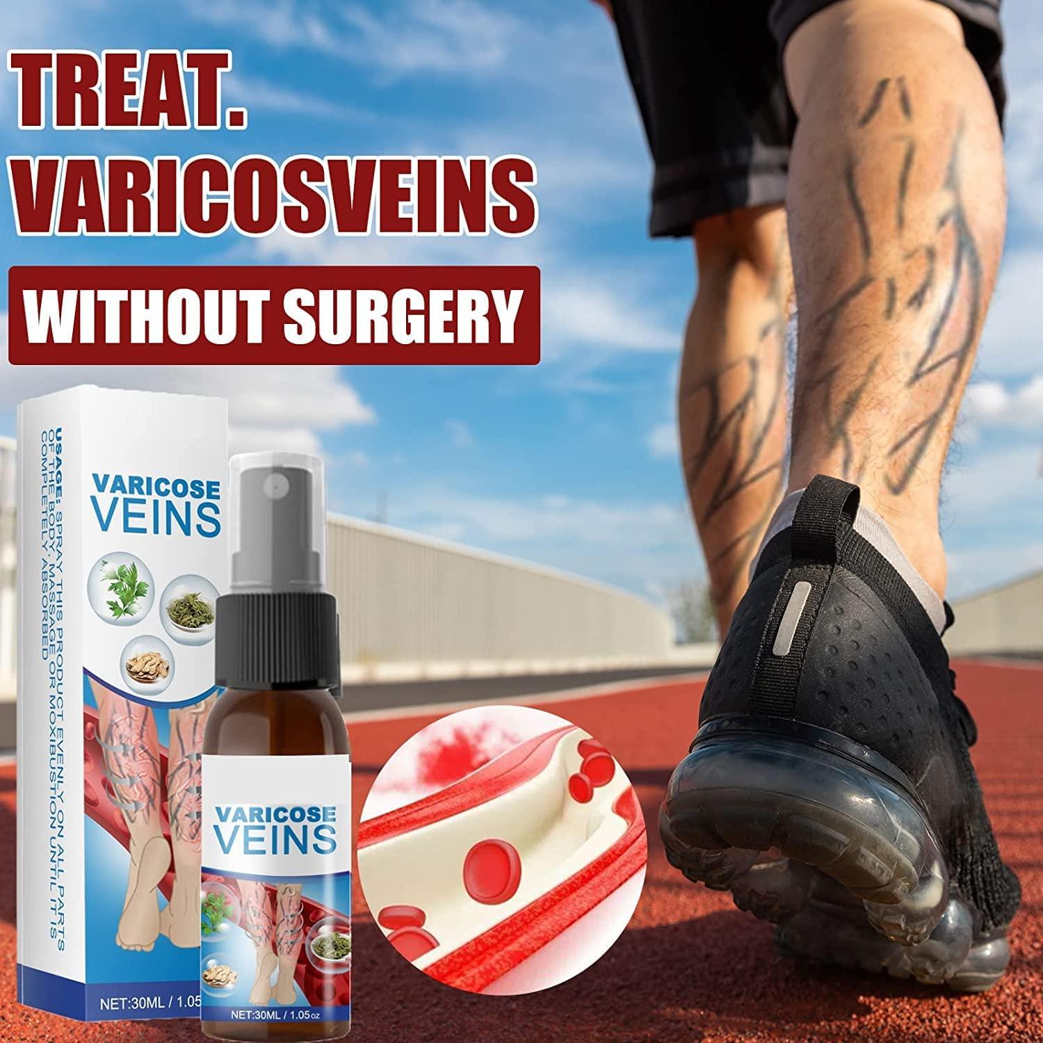 Anshka Varicose Veins Spray,Varicose Veins Care Spray,Veinhealing Varicose Veins Treatment Spray,for Legs Improve Blood Circulation,Relief Phlebitis Angiitis Varices Inflammation (1pcs)