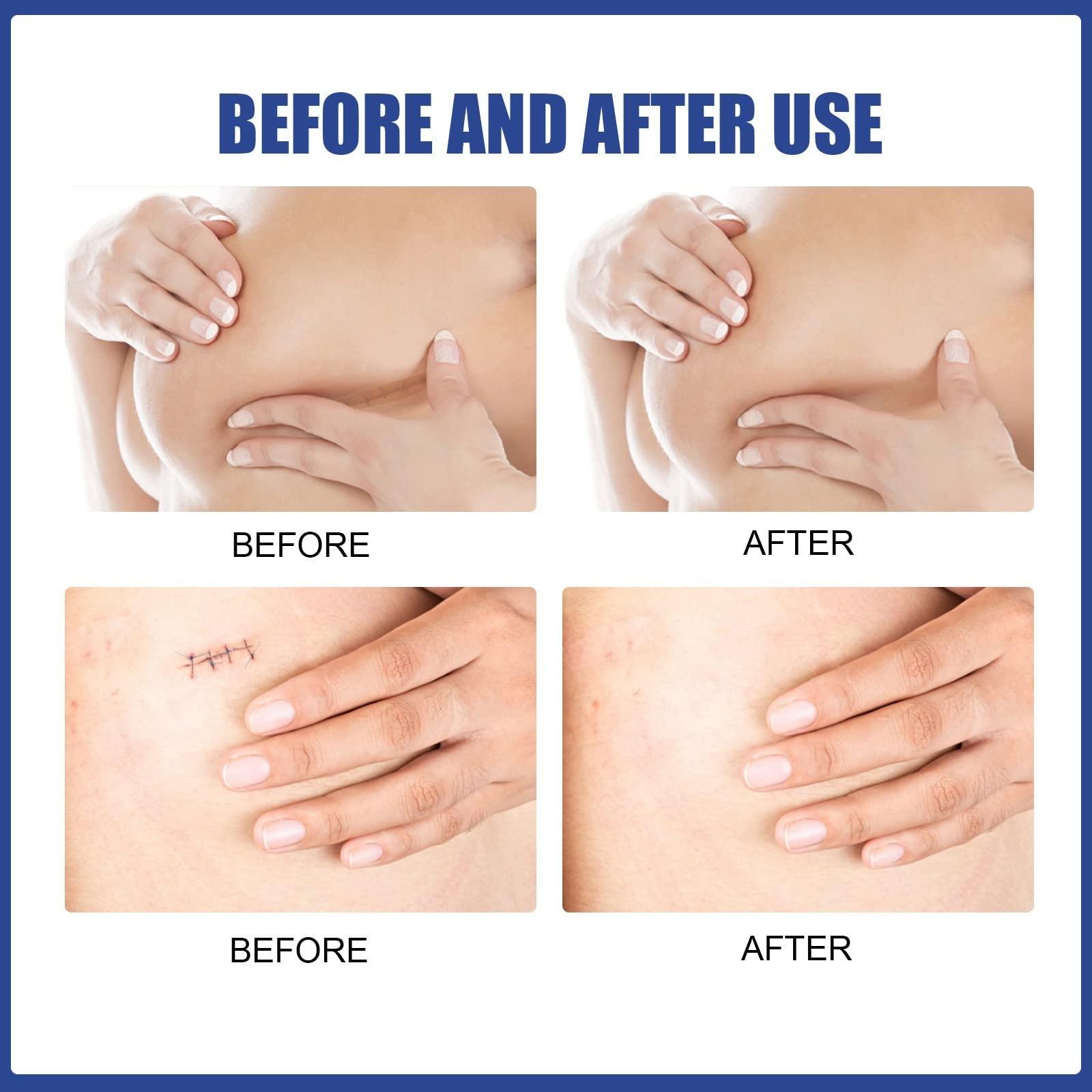 Vipomkowa 7 Line Correcting Silicone Scar Sheets Silicone Scar Sheets For Breast 8 Pack Breast Reduction After For Scar Removal Sheets 4 Areola Soft Strips 4 Sheets 2023 Graduation Gift