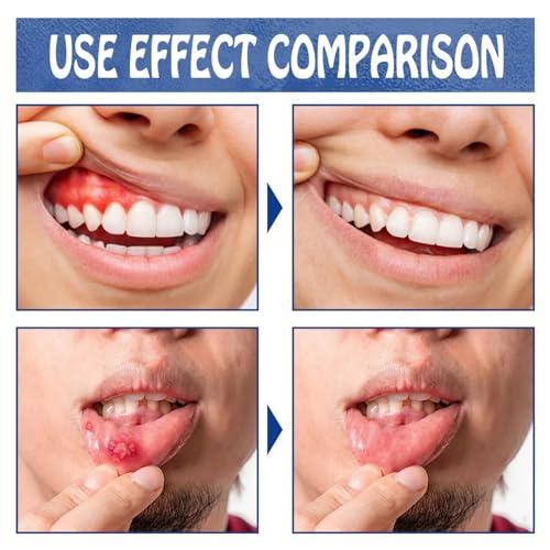 HIVETZ 2pcs Toothache Relieving Spray,Herbal Oralcare Spray,Toothache Pain Relief,Dental Pain Relief Spray,Toothache Pain Relief for Adult,Instant Teeth Treatment Relief,Strong Pain Relief for Toothache