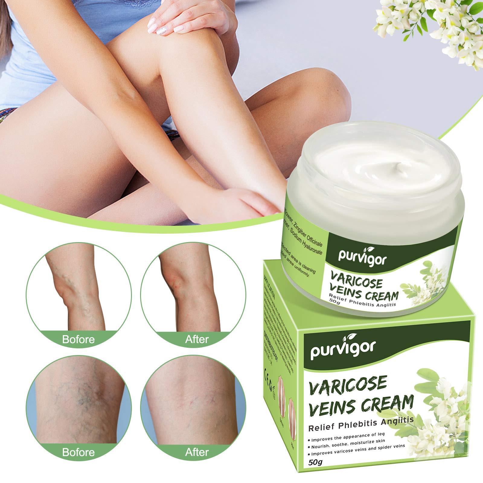 purvigor Varicose Veins Cream, Varicose Vein & Soothing Leg Cream, Natural Varicose & Spider Veins Treatment, Strengthen Capillary Health, Improve Blood Circulation, Tired and Heavy Legs Fast Relief