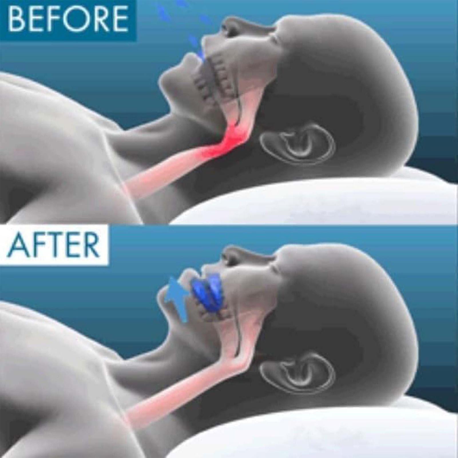 FreshCart Basics Honex Anti Snoring Mouthpiece, 4pc Relieve Snoring Mouthpiece, Sleep Apneas Mouth Guard, Reusable Quiet Anti Snore Device, Anti Snore Solution for Quieter Sleep