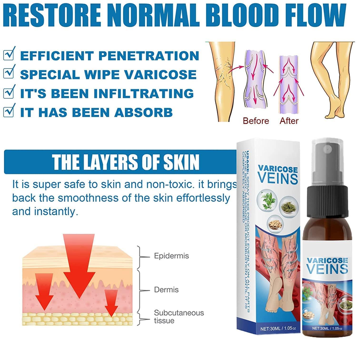 Anshka Varicose Veins Spray,Varicose Veins Care Spray,Veinhealing Varicose Veins Treatment Spray,for Legs Improve Blood Circulation,Relief Phlebitis Angiitis Varices Inflammation (1pcs)