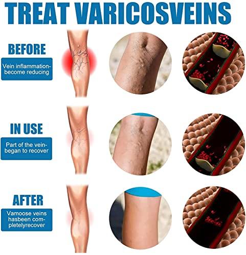 Anshka Varicose Veins Spray,Varicose Veins Care Spray,Veinhealing Varicose Veins Treatment Spray,for Legs Improve Blood Circulation,Relief Phlebitis Angiitis Varices Inflammation (1pcs)