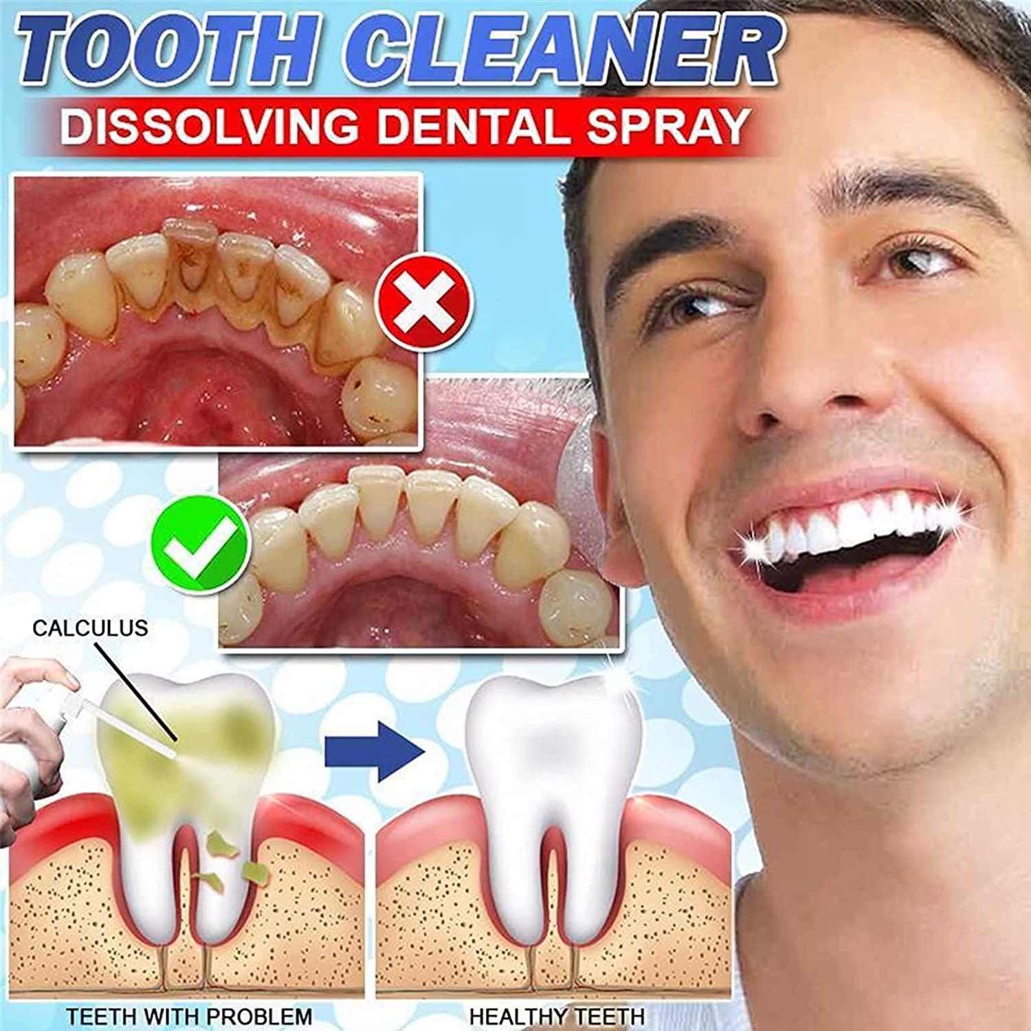 Anshka 30ml Calculusfree Dissolving Dental Spray,Dental Calculus Remover Teeth Cleaner,Mouth Refreshing Spray,Plaque Remover for Teeth Mouthwash,Intensive Stain Removal Toothpaste (2pcs)