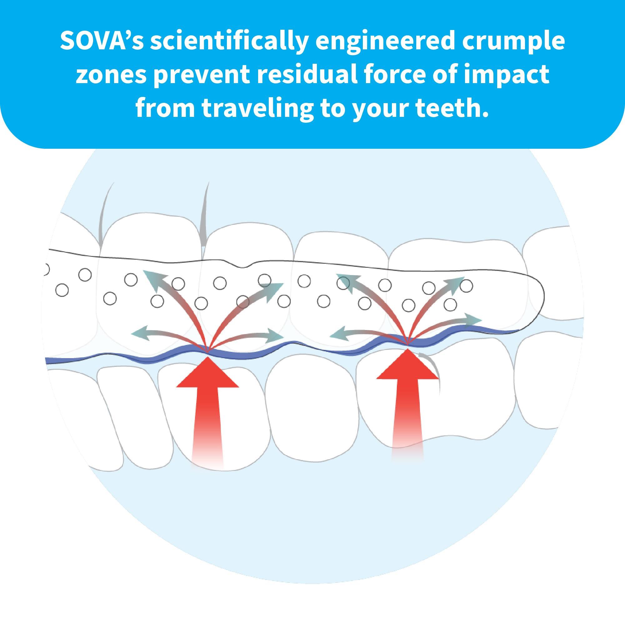 SOVA Sova Nightguard for Teeth Clenching, Grinding with Case Custom Fit Mouthguard Dental Night Guard Teeth Gum Shield for Grinding Teeth