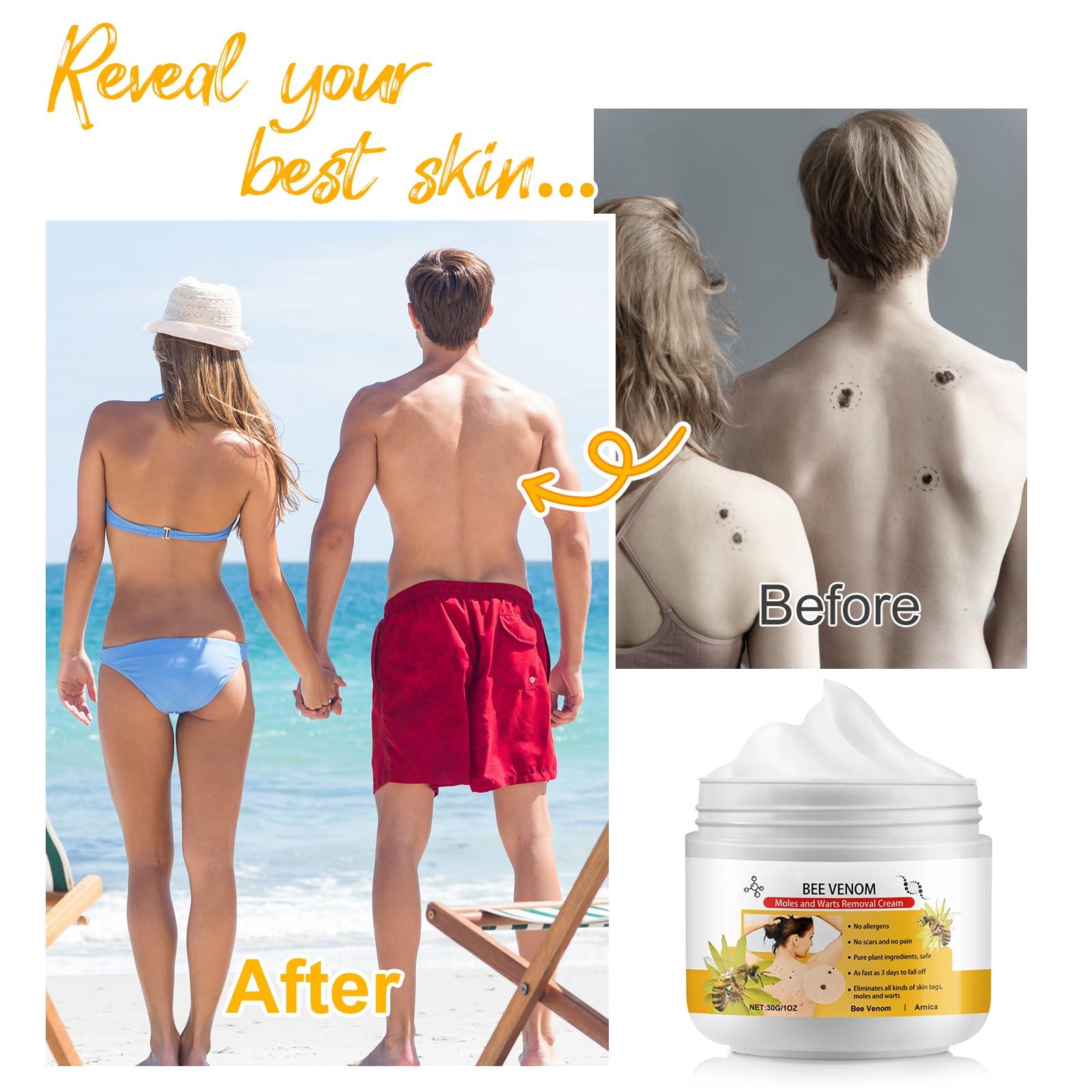 XAYGHE Bee Venom Cream, Bee Venom Wart and Tag Removal Treatment Cream, Hydrating Moisturiser, Removes Spots, Soothes Skin, for All Skins