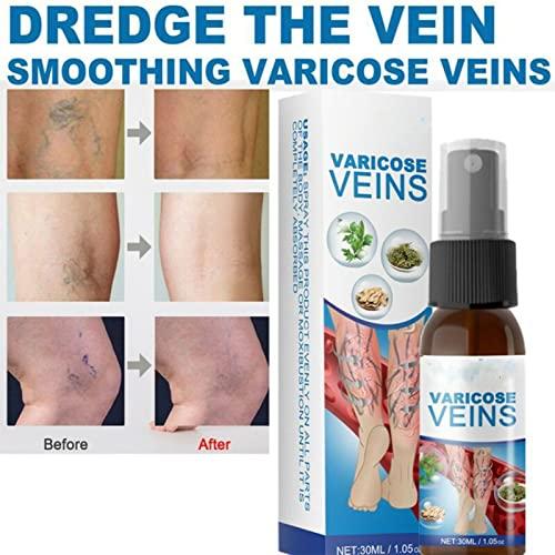 Anshka Varicose Veins Spray,Varicose Veins Care Spray,Veinhealing Varicose Veins Treatment Spray,for Legs Improve Blood Circulation,Relief Phlebitis Angiitis Varices Inflammation (1pcs)