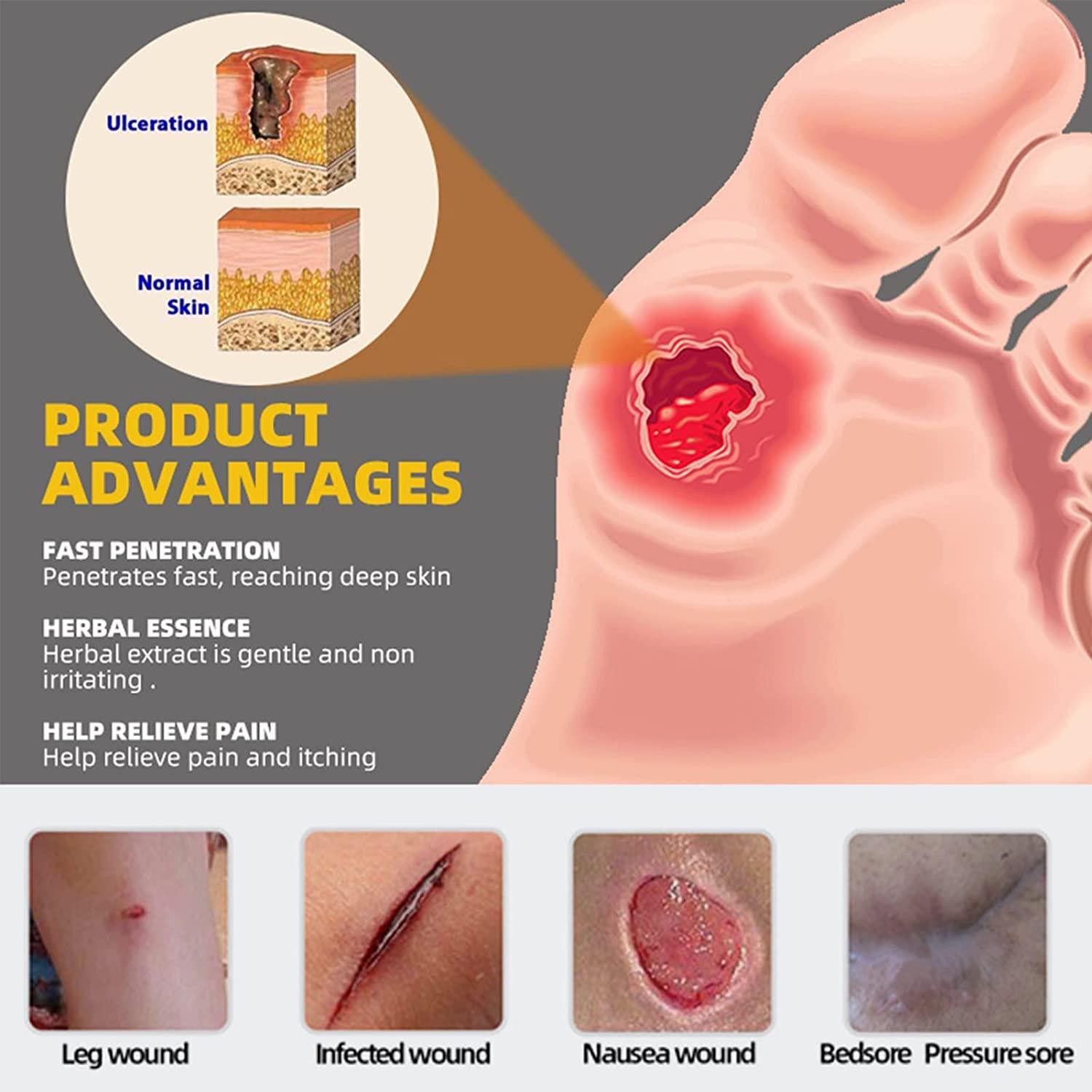 Eeiiey Bed Sore Treatment Cream,Bed Sores Healing Cream,Pressure Sore Relief Cream (1 Pcs)