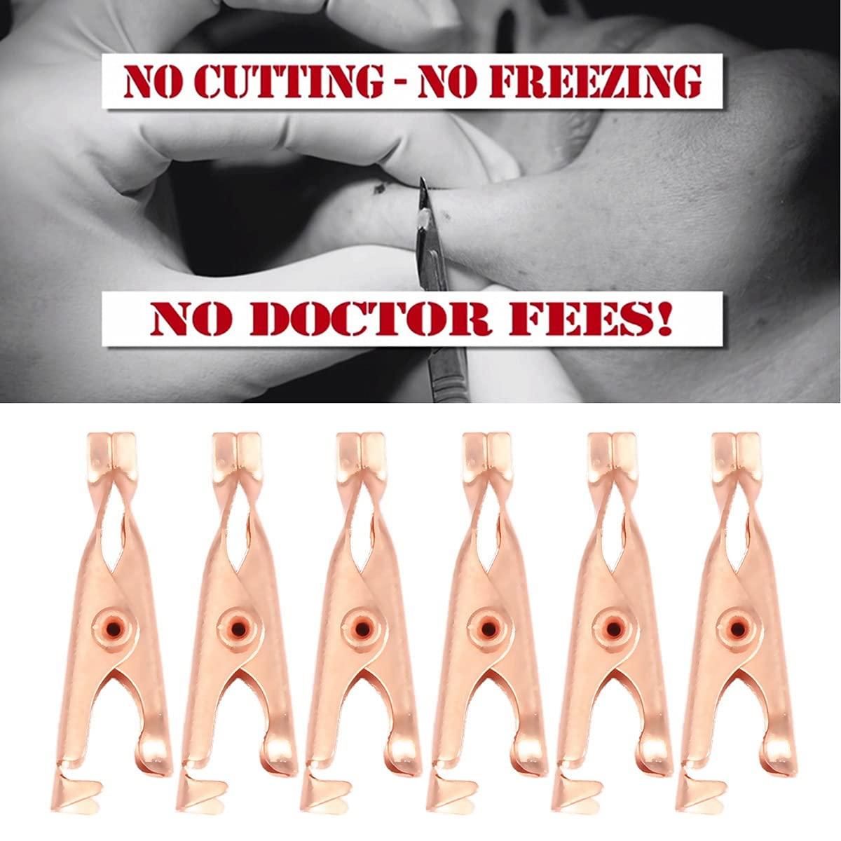 Dawafit Dawafit 1 Box/12Pcs Copper Skin Tag Remover Clips Wart Tag Extractor Copper Tag Out Skin Tag Removal Tool