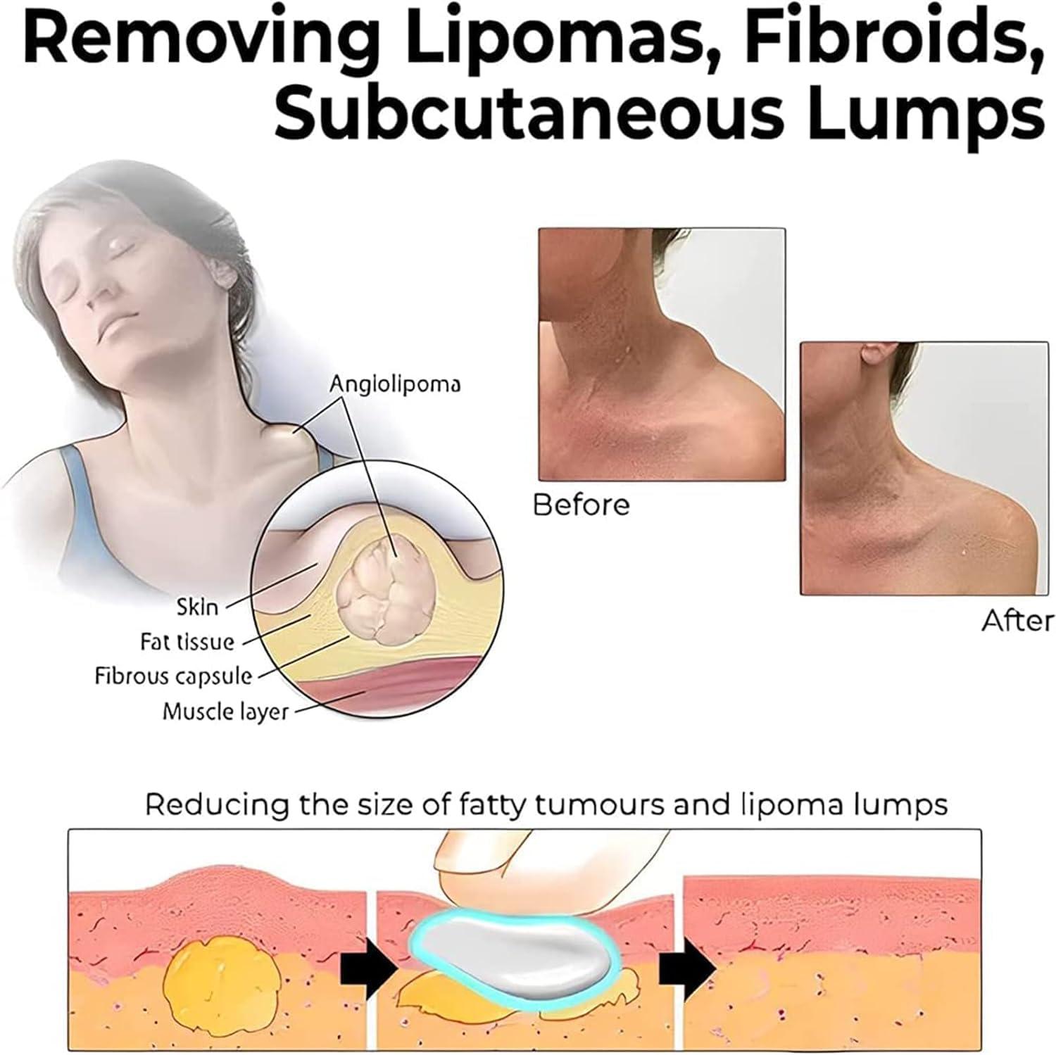 Giurui Lumpfree Lipoma Removal Cream,Lump Free Lipoma Removal Ointment Humans for Fatty Tissue, Removal Relieving Subcutaneous Lumps (3 Pcs)