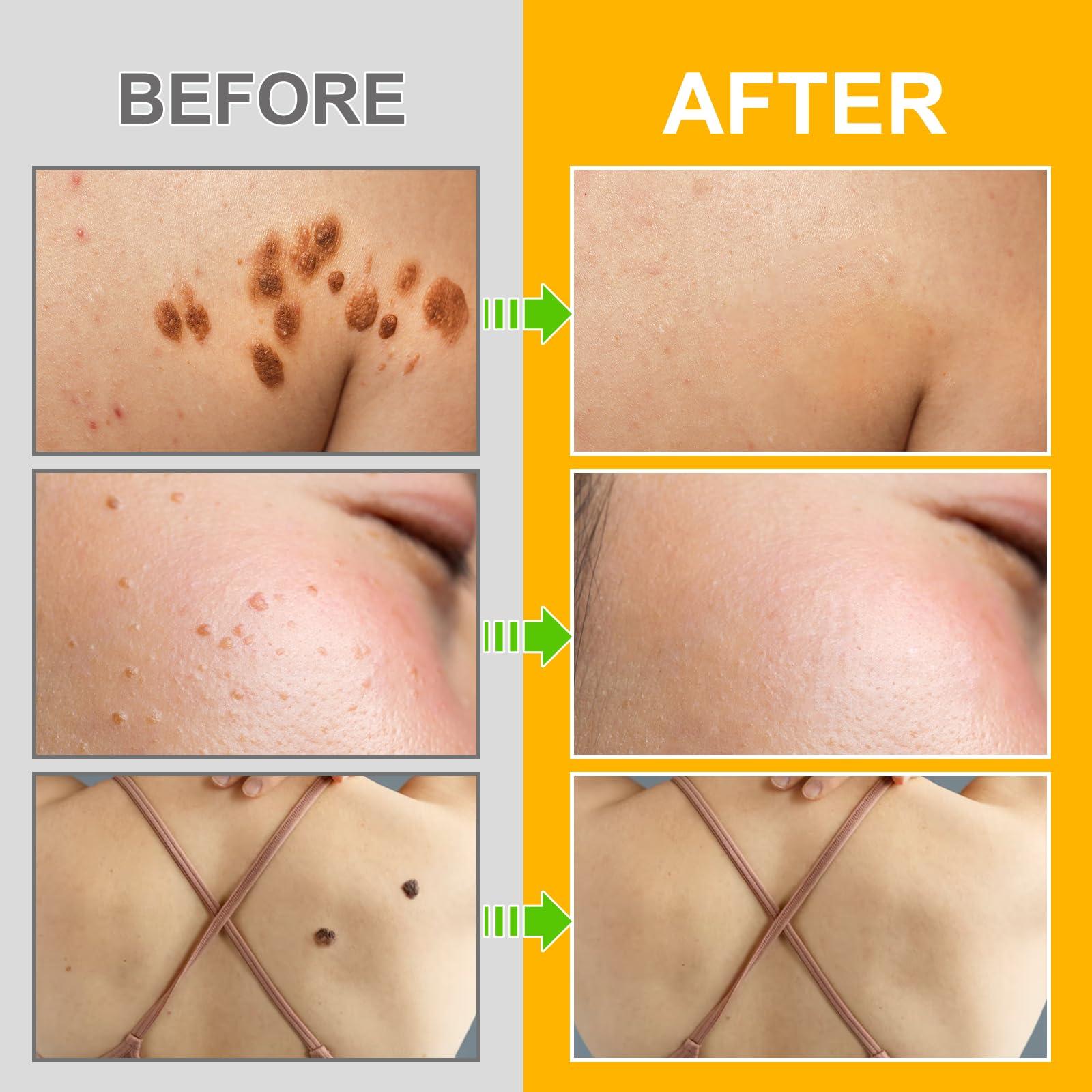 XAYGHE Bee Venom Cream, Bee Venom Wart and Tag Removal Treatment Cream, Hydrating Moisturiser, Removes Spots, Soothes Skin, for All Skins