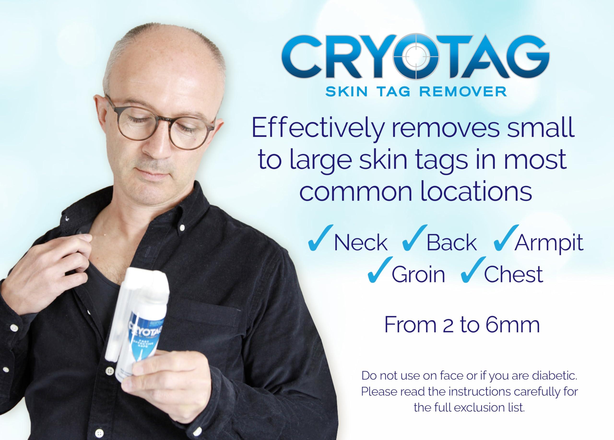 Cryotag Cryotag Skin Tag Remover - Fast Effective Safe Skin Tag Removal- Removes Skin Tags in as little as 1 treatment, Clinically Proven, Up to 12 treatments