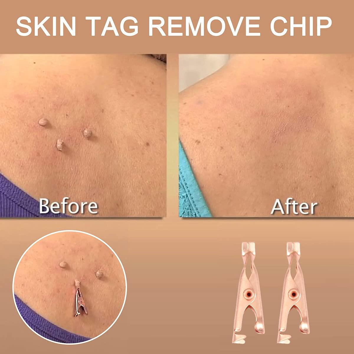 Dawafit Dawafit 1 Box/12Pcs Copper Skin Tag Remover Clips Wart Tag Extractor Copper Tag Out Skin Tag Removal Tool