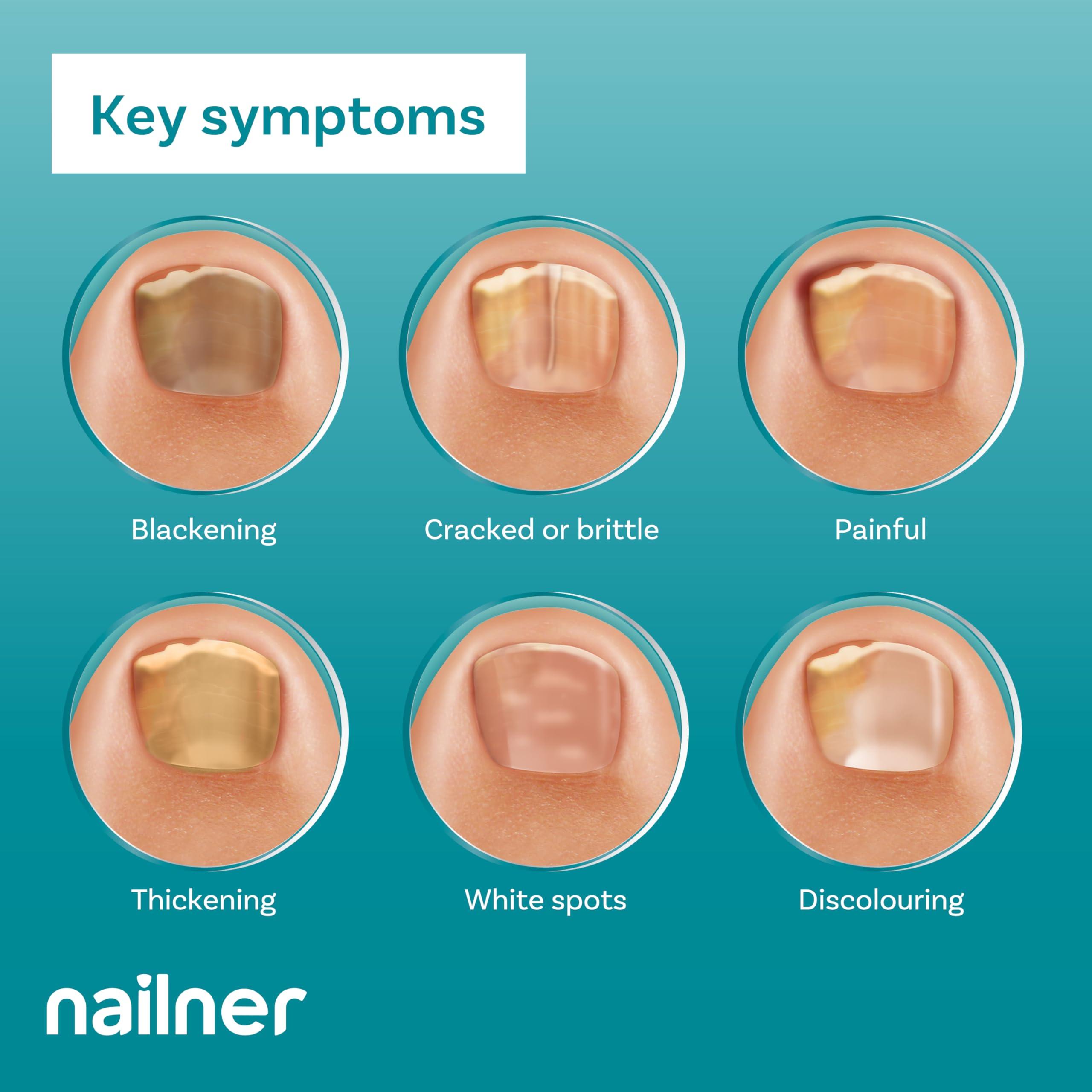 Nailner Nailner Fungal Nail Treatment Pen 4 ml - Extra Strong Anti Fungal Nail Treatment for Toenails - 2 in 1 Treat & Prevent Toe Nail Fungus - Antifungal Nail Infection - Clinically Tested & Fast Results