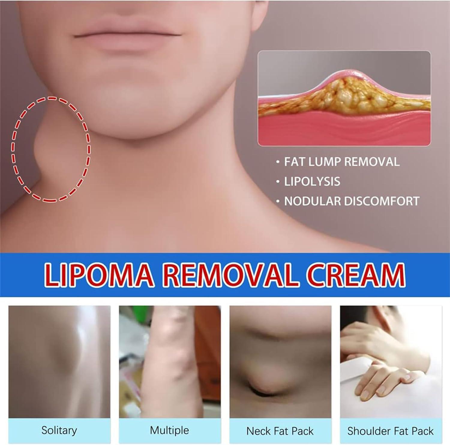 Giurui Lumpfree Lipoma Removal Cream,Lump Free Lipoma Removal Ointment Humans for Fatty Tissue, Removal Relieving Subcutaneous Lumps (3 Pcs)