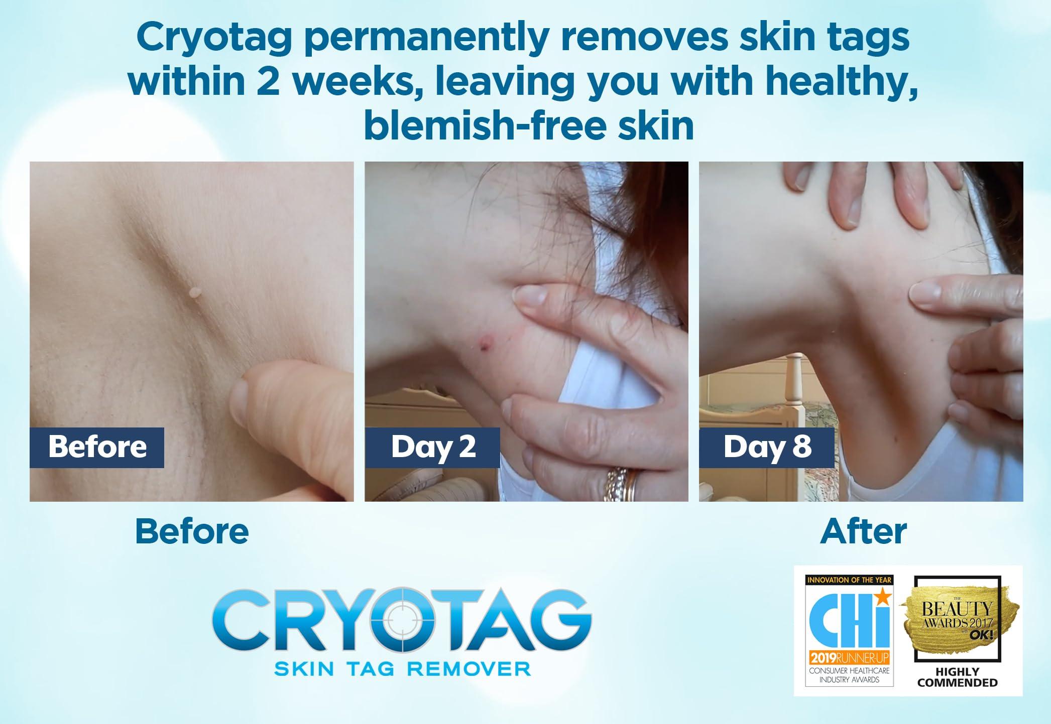Cryotag Cryotag Skin Tag Remover - Fast Effective Safe Skin Tag Removal- Removes Skin Tags in as little as 1 treatment, Clinically Proven, Up to 12 treatments