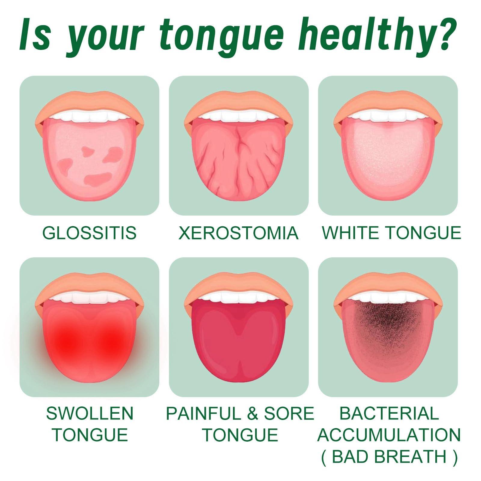 HIVETZ Tongue Repair Spray,Moisturizing Dry Mouth Spray,Fissured Tongue Relief Spray,Instant Dry Mouth Relief,Breath Freshener Spray for Tongue Relief,Tongue Relief Treatment,for White Coating and Bad Breath