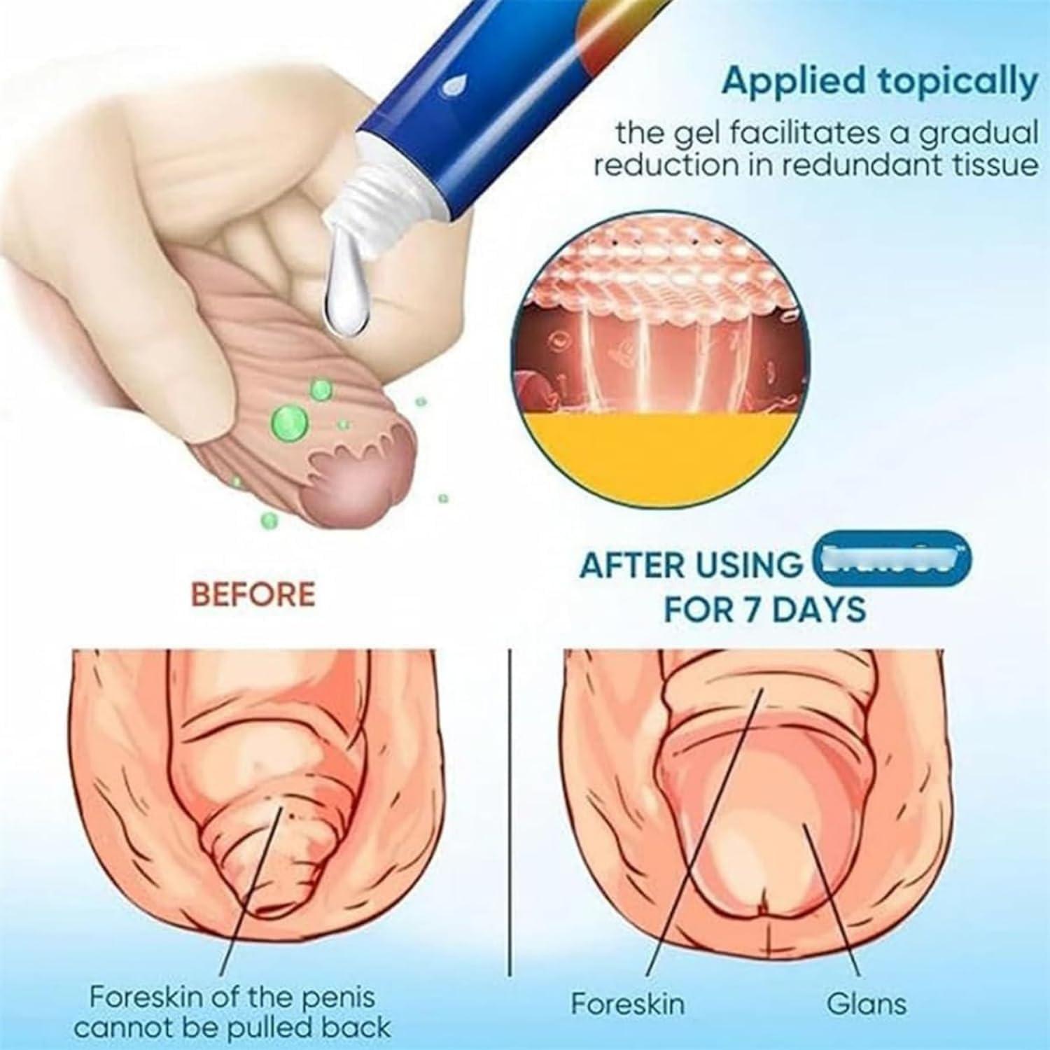 Endyniner BruteCo Redundant Prepuce Corrector Gel, Natural Ingredients Phimosis Foreskin Correction Gel, Correction Gel for Excessive Foreskin, Fast and Gentle Action, Effective Relief (1pcs)