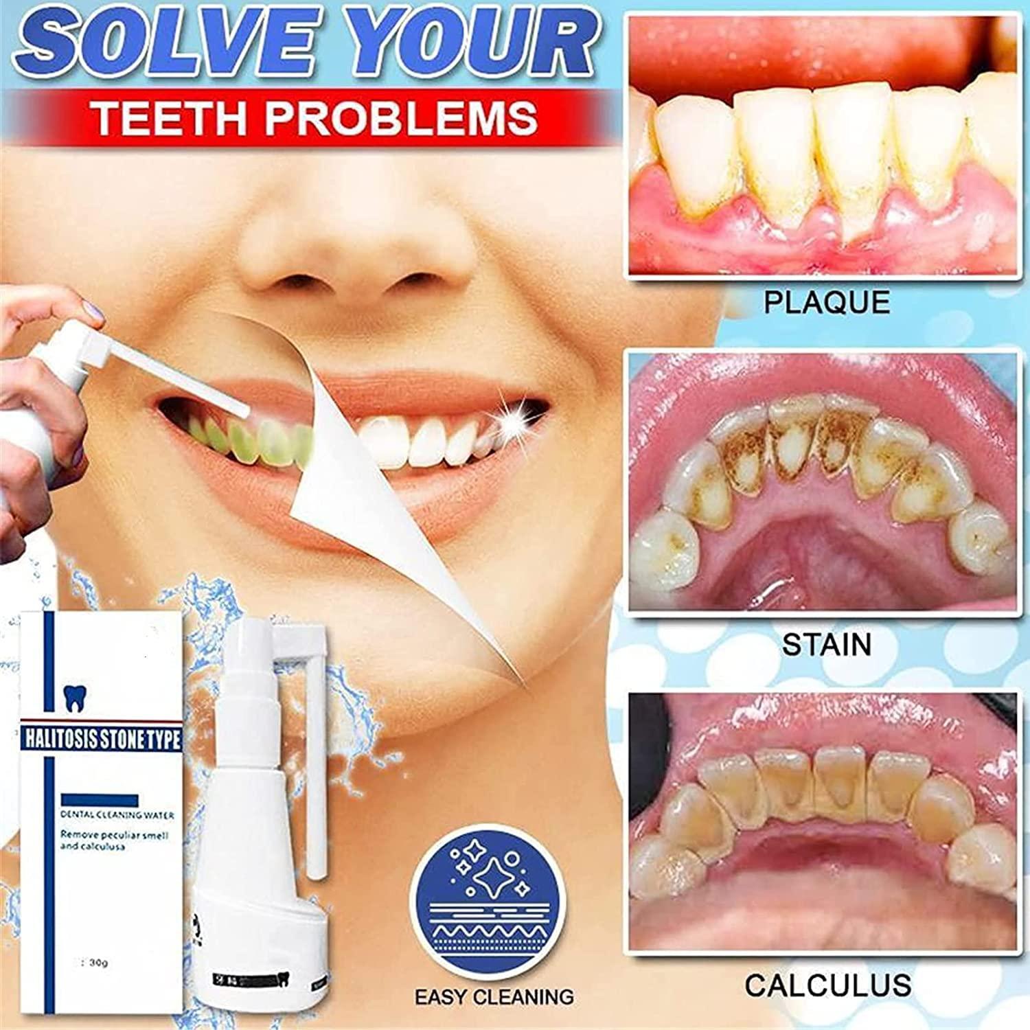 Anshka 30ml Calculusfree Dissolving Dental Spray,Dental Calculus Remover Teeth Cleaner,Mouth Refreshing Spray,Plaque Remover for Teeth Mouthwash,Intensive Stain Removal Toothpaste (2pcs)