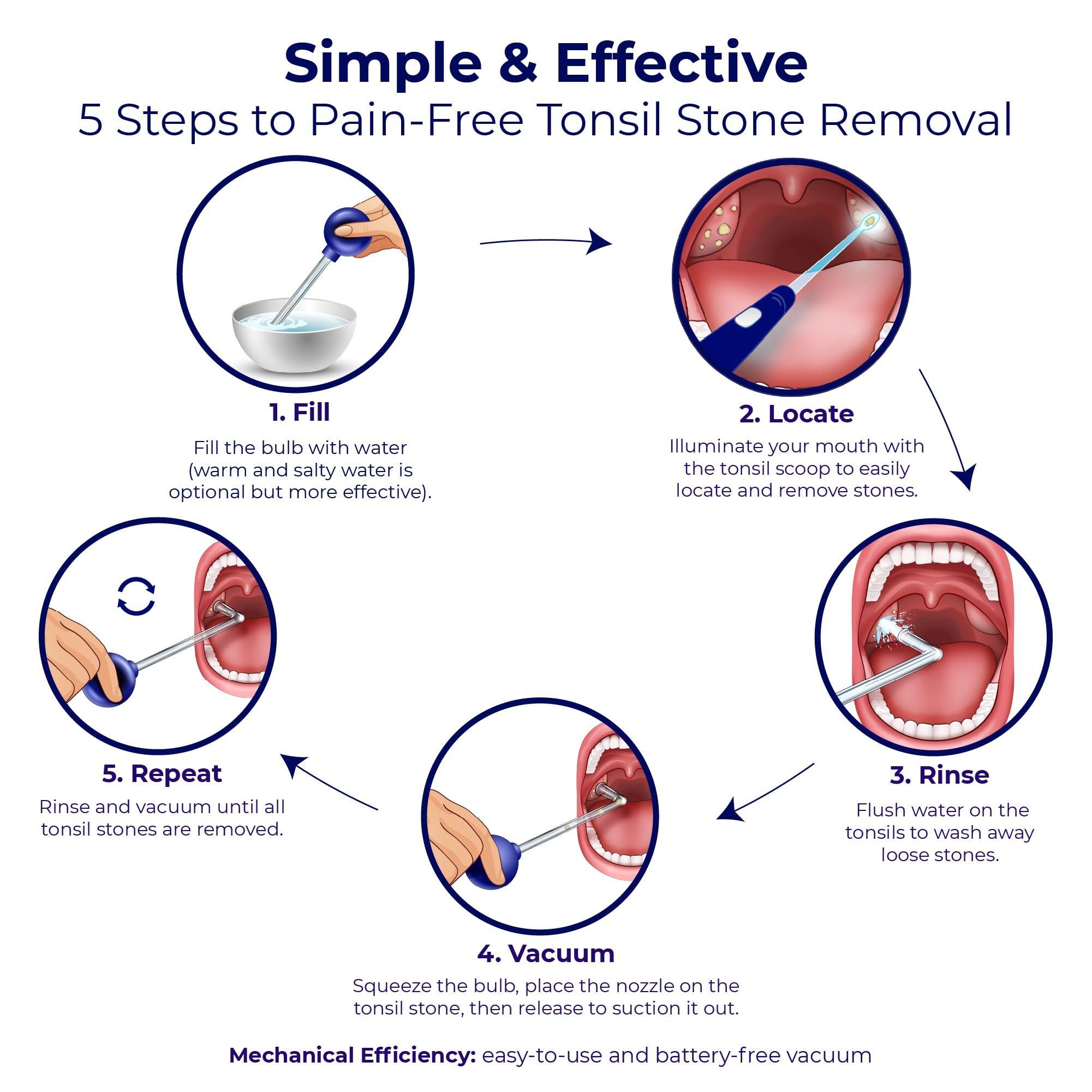 ORAVIX Oravix Tonsil Stone Remover Vacuum, Tonsil Stone Remover for Bad Breath Treatment, Tonsil Stone Suction Tool, Tonsil Stones Remover, Tonsil Stone Remover Vacuum Pump, Tonsil Stone Vacuum