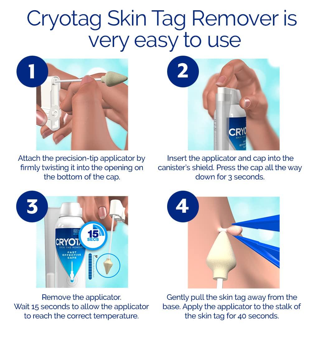 Cryotag Cryotag Skin Tag Remover - Fast Effective Safe Skin Tag Removal- Removes Skin Tags in as little as 1 treatment, Clinically Proven, Up to 12 treatments